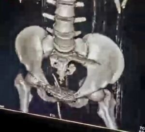 صحة الدقهلية  نجاح فريق طبي بمستشفى أجا فى إجراء جراحة دقيقة استمرت 7 ساعات