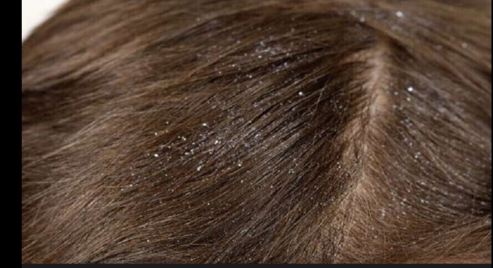 قشرة الرأس وأسبابها المتنوعة وكيفية التعامل معها بفعالية