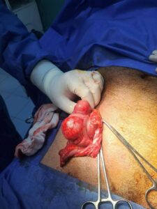 صحة الدقهلية: إنقاذ حياة مريض بفتق نادر خلال تدخل جراحي عاجل بمستشفى ميت سلسيل